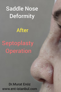 Saddle Nose Deformity Definition