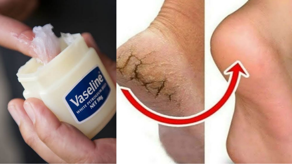 Vaseline là cách hữu hiệu nhất trị nứt nẻ cho những vùng da dày như gót chân.