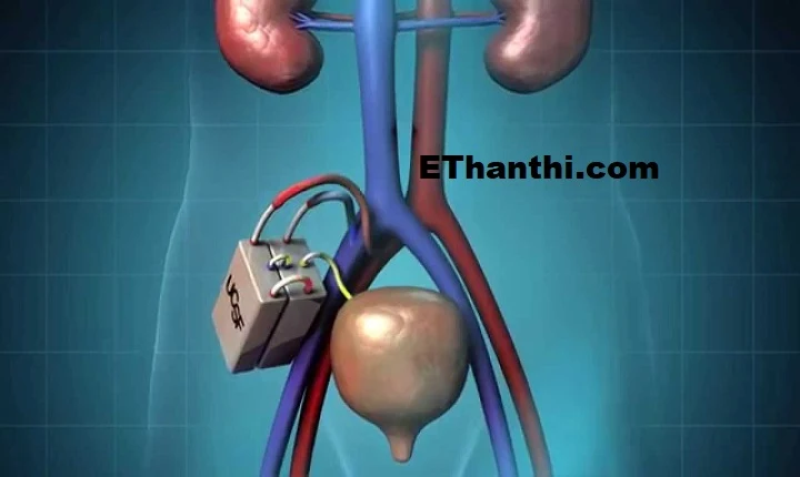 செயற்கைச் சிறுநீரகம்... தெரியுமா? உங்களுக்கு !