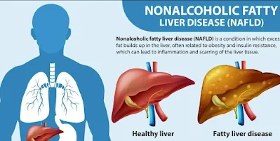 What is Nonalcoholic Fatty Liver Disease (NAFLD) - healthy bel