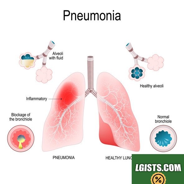 Streptococcus Pneumonia Symptoms