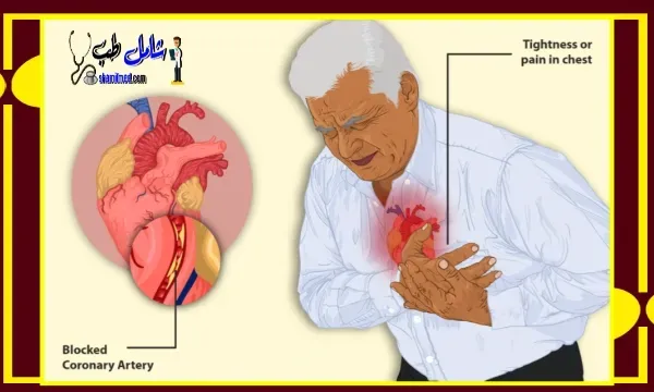 مرض الشريان التاجي؟ تعريف مرض الشريان التاجي؟ الأسباب، الأعراض، وطرق علاج مرض الشريان التاجي؟ coronary artery disease,coronary artery disease (disease or medical condition),coronary artery disease treatment,heart disease,coronary heart disease,coronary artery disease nursing,coronary artery,coronary artery disease animation,coronary artery disease pathophysiology,cad coronary artery disease,coronary artery disease video,coronary artery disease symptoms,coronary artery disease overview,coronary artery disease explainer,coronary arteries
