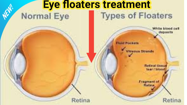 Eye floaters,How long do floaters in the eye last?,Are eye floaters normal?,Will eye floaters go away?,What is the treatment for most eye floaters?,Eye floaters - Symptoms,Eye floaters treatment,Headache and eye floaters,What causes eye floaters,Types of eye floaters,Eye floaters NHS,Are floaters in the eye dangerous,Sudden floaters in one eye