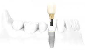 Cấy ghép răng Implant -2