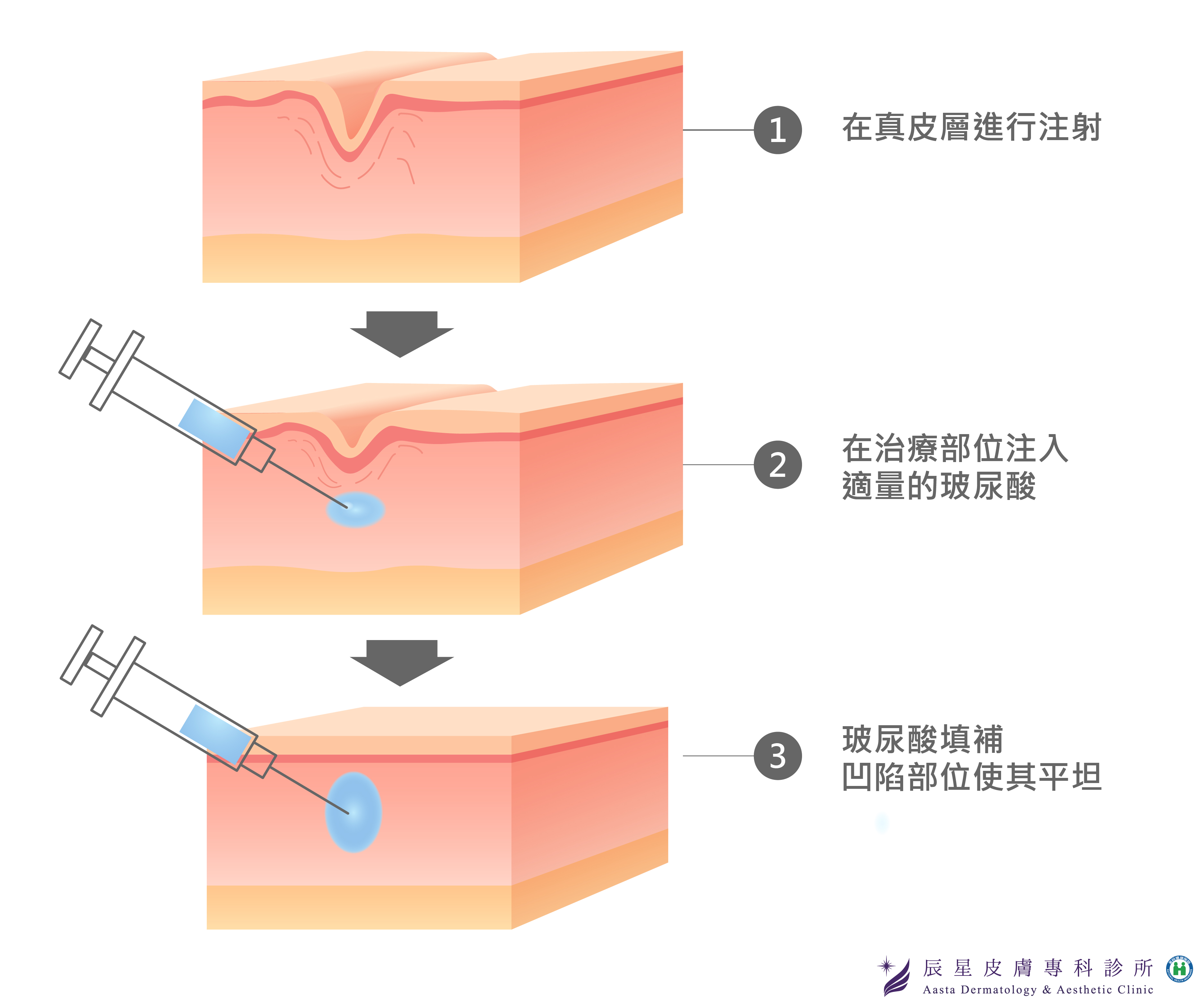 玻尿酸效果