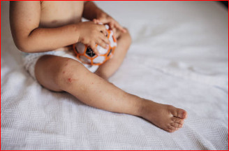 How to Identify Hand, Foot and Mouth Disease