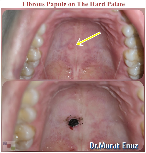 Fibrous Papule,angiofibromas, excisional biopsy of the hard palate,Papule fibreuse,