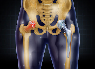Hip replacement is a surgical operation in which a prosthetic implant is used to replace a hip joint.
