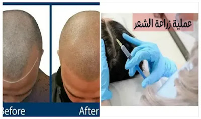 عملية زراعة الشعر  مراحلها وابرز مخاطرها