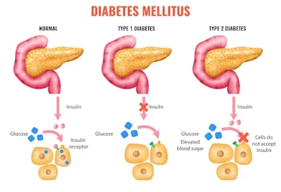 Diabetes Mellitus- Healthy Bel