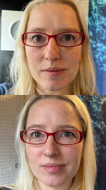 Before and after photos from using SKINKISSED showing little difference