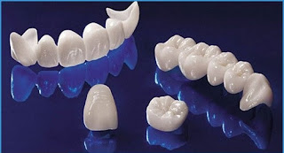Những trường hợp nên bọc răng sứ-1