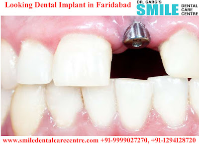 Best Dental Implant Clinic in Faridabad