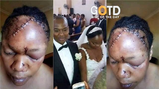 Disastrous! Husband dismantled His Wife Face Some Weeks after their marriage (Photos)