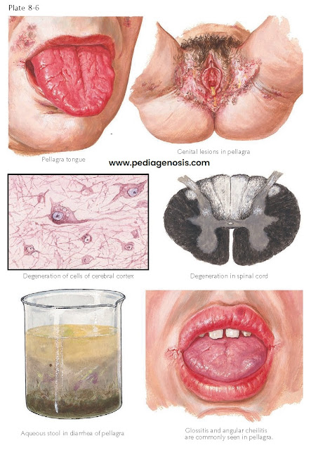 MUCOSAL AND CENTRAL NERVOUS SYSTEM MANIFESTATIONS OF PELLAGRA