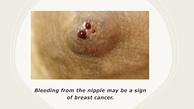 Blood coming from the nipple might be a sign for breast cancer.