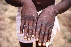 La OMS cambia nombre de la viruela del mono por "mpox"
