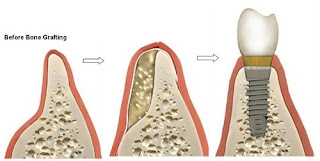 Trồng răng implant có tốt không-2