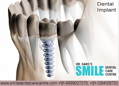 Best Dental Implant Clinic in Faridabad