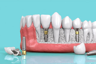 Bảng giá trồng răng implant mới nhất-3
