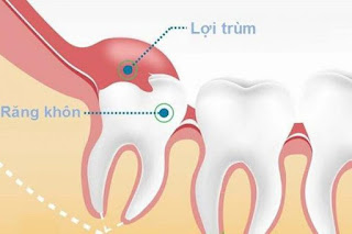 Lợi trùm khi mọc răng khôn điều trị ra làm sao?-1