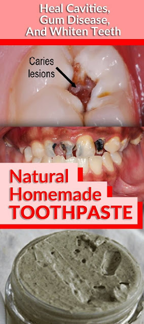 Natural Homemade Toothpaste for Heal Cavities