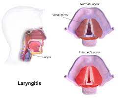 Laryngitis Throat Pain