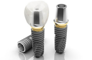 Quy trình cấy ghép răng implant -2