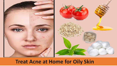Treat Acne at Home for Oily Skin
