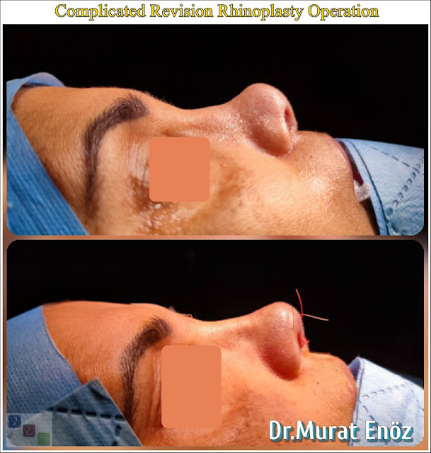 Complicated Revision Rhinoplasty in Istanbul, revision nose job,Overreducted Nose Hump, Asymmetrical Nostrils, Asymmetrical Nose Bone, Hanging Columella