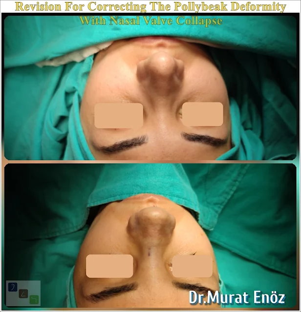 Nasal valve collapse, Pollybeak Deformity, Polly Beak Nose Deformity,