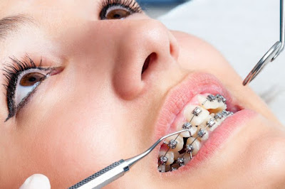 Harga Pasang Behel Di Sukoharjo Apic Dentistry Klinik Gigi