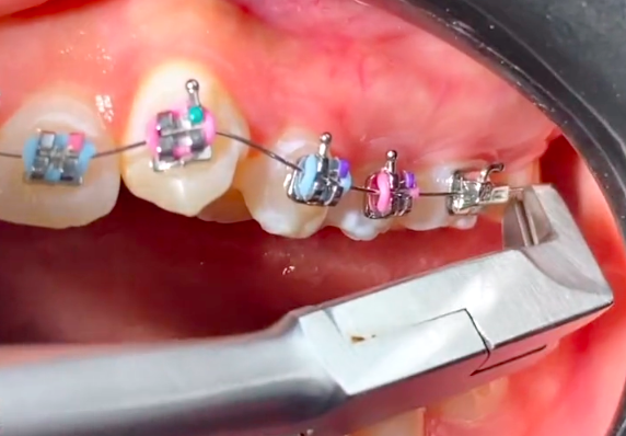 Cómo cortar un pedazo de alambre de los brackets? - Blog - Odontover