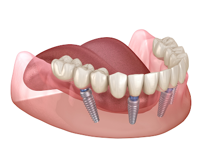 Root Canal vs Dental Implants