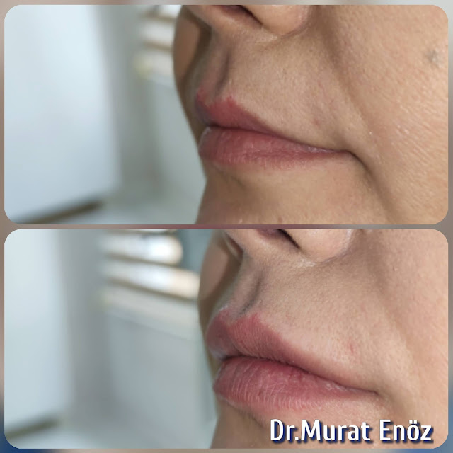 Lip Filler Injection - Augmentation in Istanbul