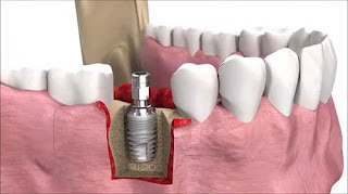 Cấy ghép răng implant-2