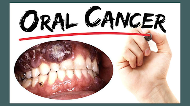 Define of Tongue Cancer and Signs and Symptoms Oral Cancer | Treatment