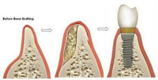 Trồng răng implant có nguy hiểm không-3