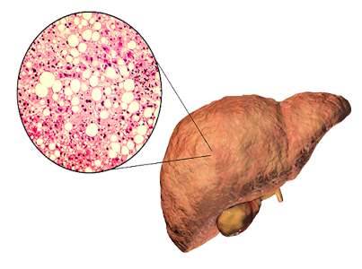 Fatty Liver and the Natural Remedies