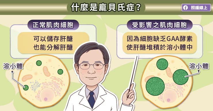 什麼是龐貝氏症？