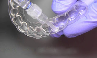 Phương pháp niềng răng không mắc cài 3D Clear-1