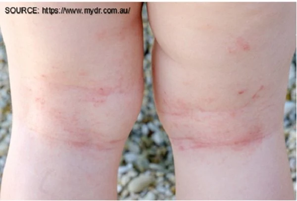 symptoms of Eczema