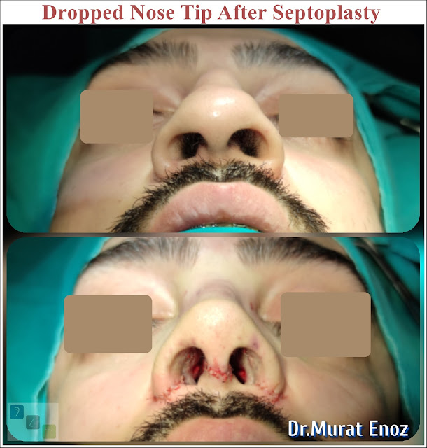 Nose Tip Lifting,Droopy Nose Tip After Nose Surgery,open technique septoplasty,Dropped Nose Tip Aesthetic in Men,droopy nose tip aesthetic,Ptotic Nasal Tip,Male Nose Job, Rhinoplasty in Men Istanbul