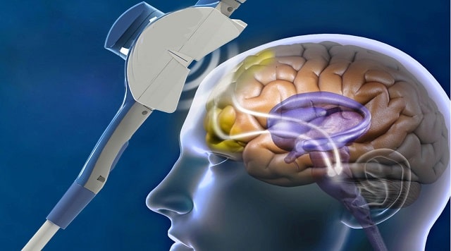 tms treatment depression transcranial magnetic stimulation