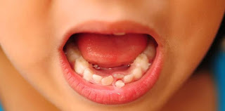 Nha sĩ khuyến cáo cần nhổ răng sữa cho trẻ đúng cách-3