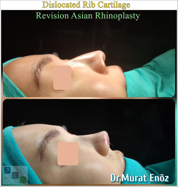 Ethnic Asian Thick Skinned Rhinoplasty Dislocated and Crooked Rib Cartilage - Asian Nose Job