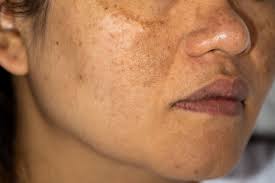 WHAT IS PIGMENTATION? MAIN CAUSES OF IT, REASONS OF PIGMENTATION ON FACE, CAN IT BE REMOVED? WHICH FACIAL IS BEST FOR IT? DIET FOR IT, TAN /BROWN PIGMENTATIOM. DIAGNOSIS, TREATMENT