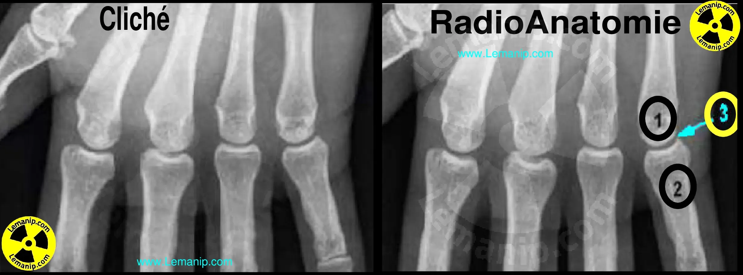 fractured 5th metacarpal treatment,broken 5th metacarpal treatment,broken 4th metacarpal,fractured 4th metacarpal,broken fourth metacarpal,fractured fourth metacarpal,broken hand metacarpal,fractured 5th metacarpal,broken fifth metacarpal,fractured fifth metacarpal