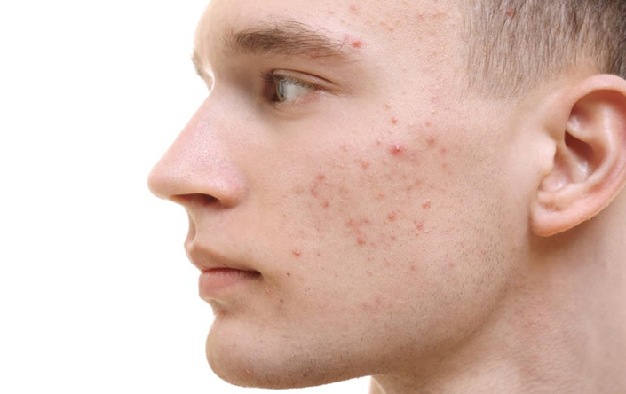 Best Treatments For Acne by Skin Specialist in Punjab