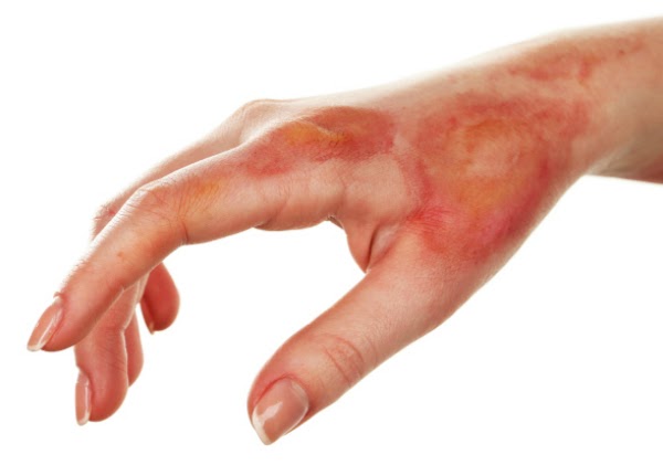 All You Need To Know About Radiodermatitis